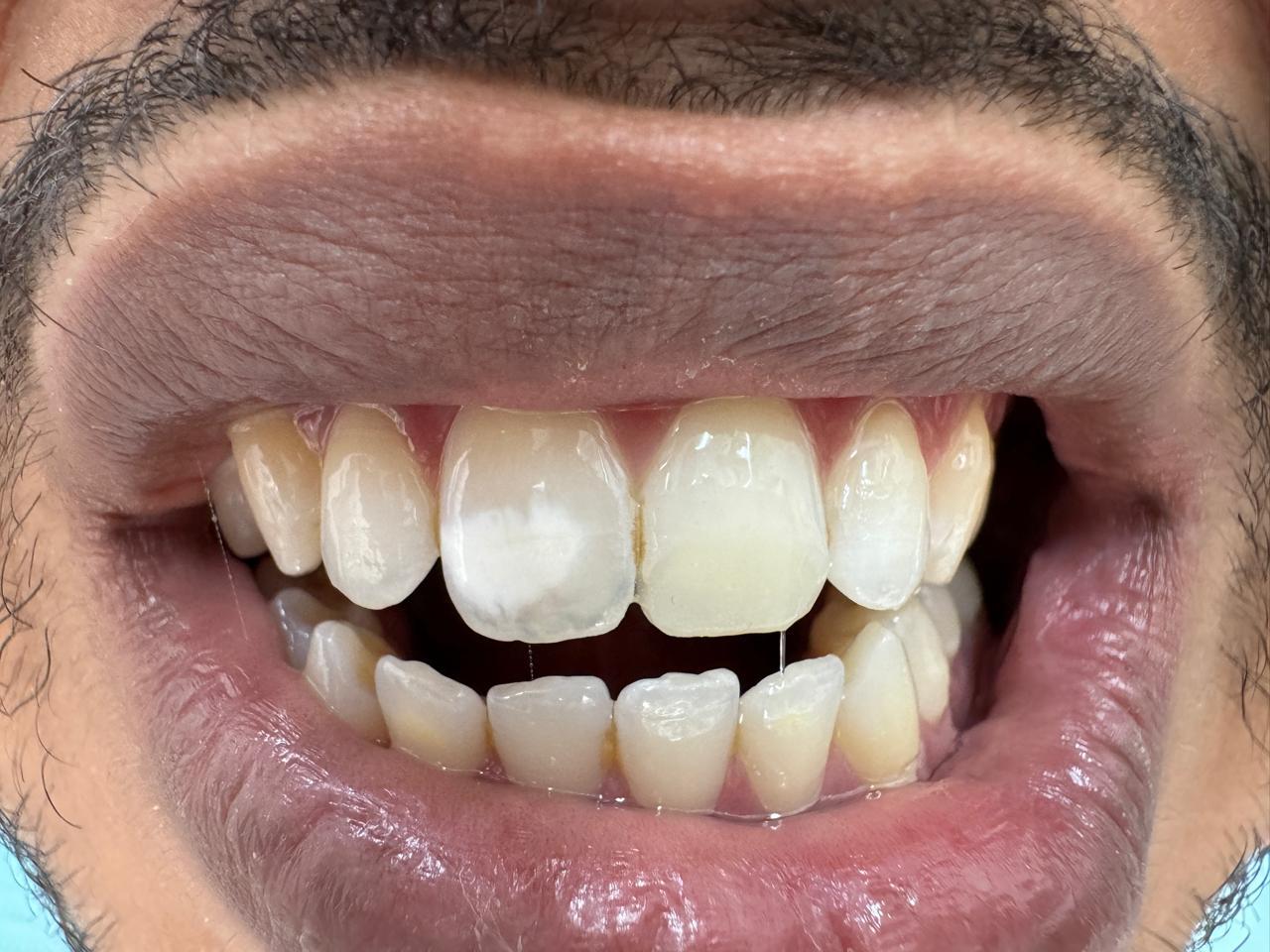 Aesthetic reshaping after treatment